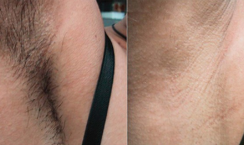 before after laser hair removal mississauga oakville